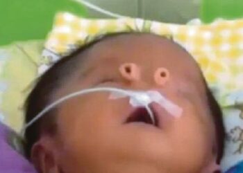 Keadaan Angelito yang dilahirkan dengan dua lubang hidung yang terkeluar dari mukanya.