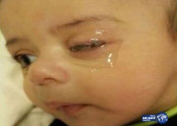 Kasihan. Keadaan mata bayi yang digam oleh abangnya. Foto dari Harian Metro
