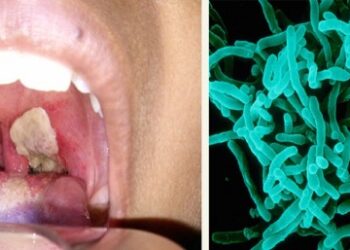 Jangkitan Difteria pada tekak dan gambar kanan, bakteria Corynebacterium Difteriae punya penyakit itu. Foto -Healthline.com/Alain Grillet