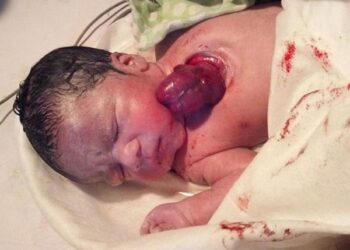 Bayi yang dilahirkan dengan jantung diluar dadanya. Foto - http://www.mynewshub.cc