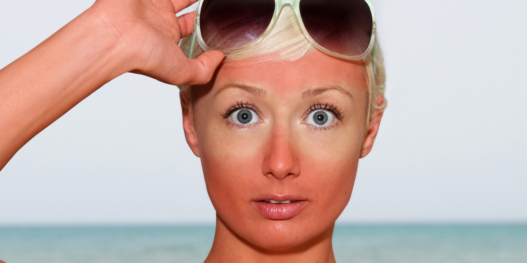 Woman raises her sunglasses revealing her sunburn